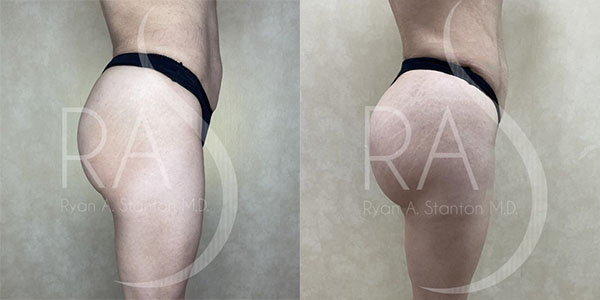 before and after right side view butt augmentation with implants female patient case 2971