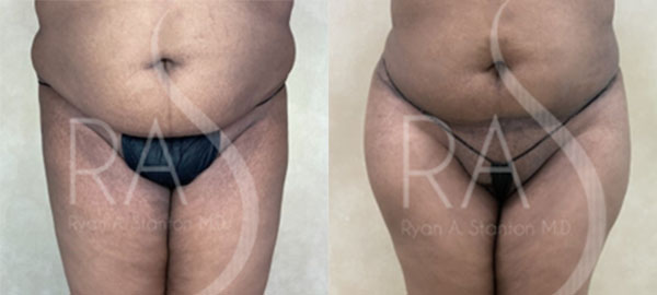 before and after front view buttock augmentation with implants female patient case 2961