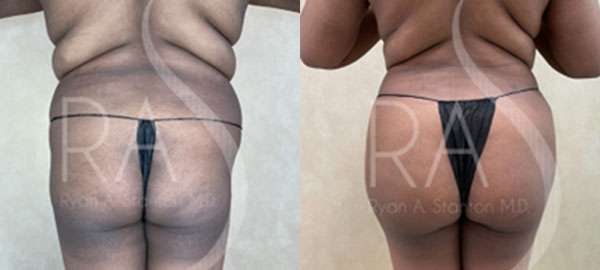 before and after back view buttock augmentation with implants female patient case 2961