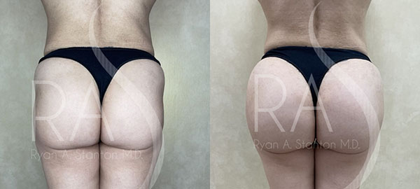 before and after back view hip augmentation with implants female patient case 2967