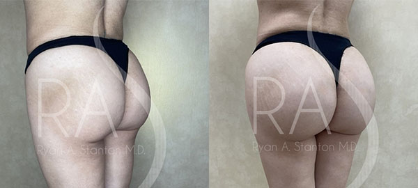 before and after left angle view hip augmentation with implants female patient case 2967