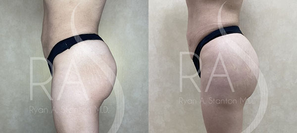 before and after left side view hip augmentation with implants female patient case 2967