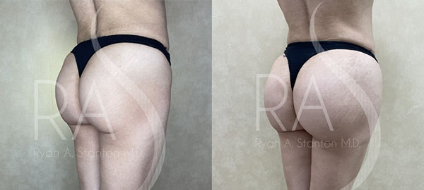 before and after right angle view hip augmentation with implants female patient case 2967