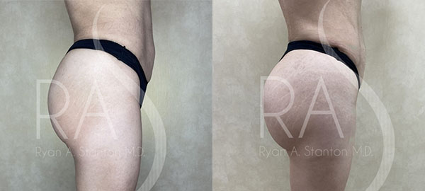 before and after right side view hip augmentation with implants female patient case 2967