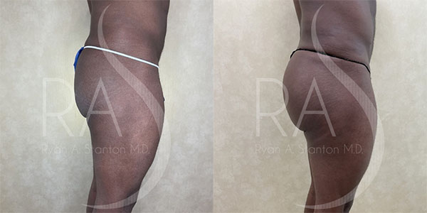 before and after right side view buttock augmentation with implants male patient case 2954