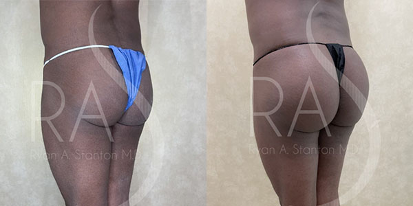 before and after left angle view buttock augmentation with implants male patient case 2954