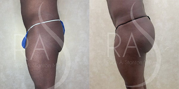 before and after left side view buttock augmentation with implants male patient case 2954