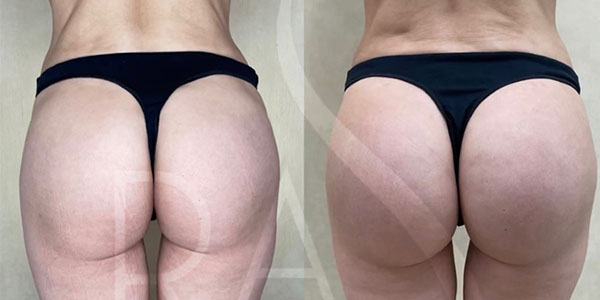 before and after left back view hip augmentation with implants female patient case 3064