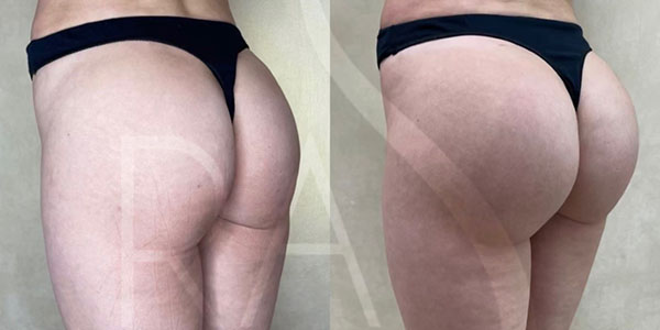 before and after left angle view hip augmentation with implants female patient case 3064