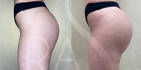 before and after left side view hip augmentation with implants female patient case 3064