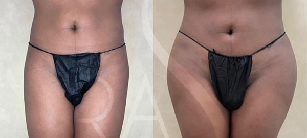 before and after front view hip augmentation with implants female patient case 3071