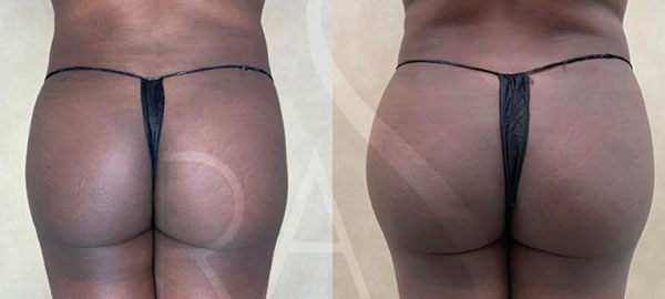 before and after back view hip augmentation with implants female patient case 3071