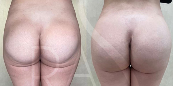 before and after back view reconstruction buttock implants female patient case 3084