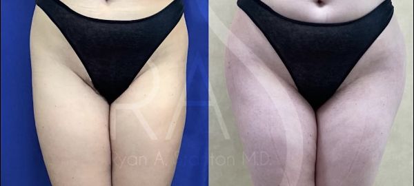 before and after hip augmentation with implants front view female patient case 3180