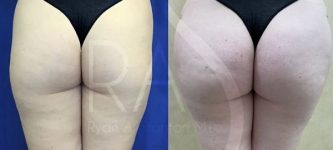 before and after hip augmentation with implants back view female patient case 3180