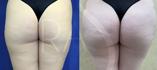 before and after hip augmentation with implants back view female patient case 3180