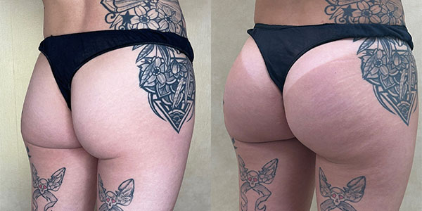 before and after buttock augmentation with implants right angle view of female patient 3317