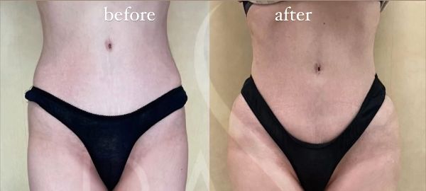 hip augmentation with implants front view of female patient 3315